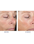 IS Clinical Active Peel System (15 Treatments)