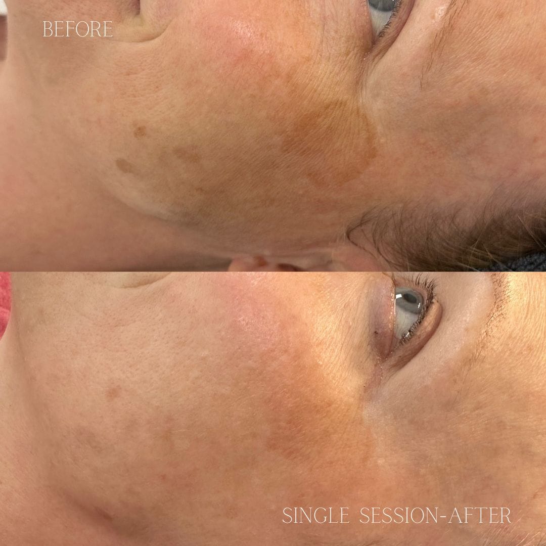 Dark Spots & Pigmentation