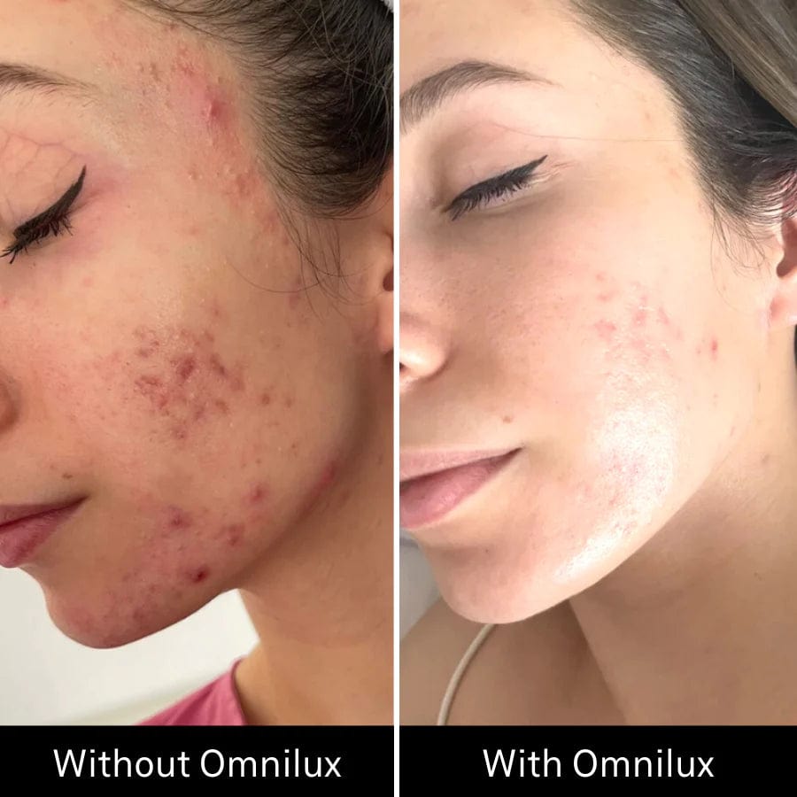 Omnilux Clear Mask