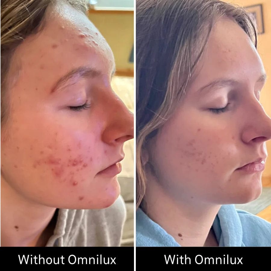 Omnilux Clear Mask