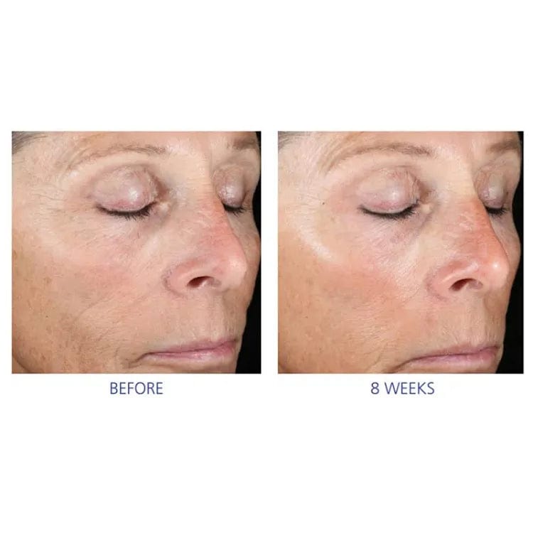 IS Clinical Active Peel System (15 Treatments)