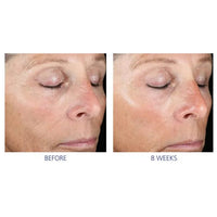 IS Clinical Active Peel System (15 Treatments)