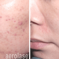NeoClear (Teen Acne Therapy) (appx 30 min)