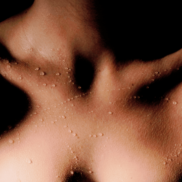 NeoSkin (Chest Rejuvenation) (appx 60 min)