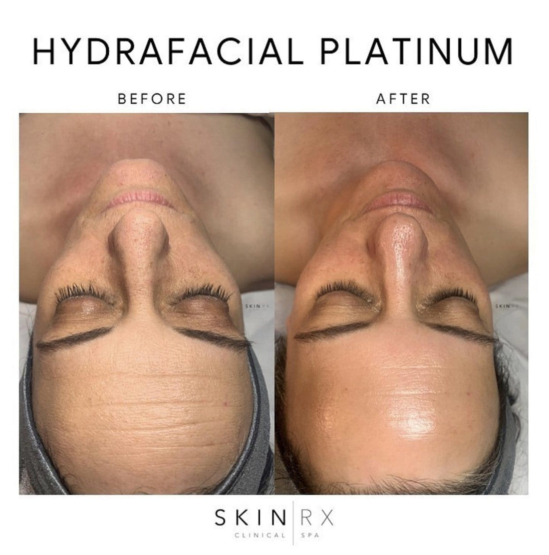 SkinRX Online Store Hydrafacial Platinum